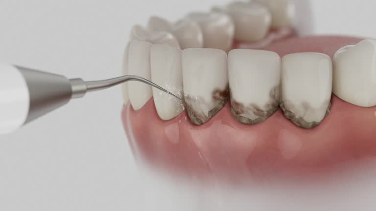 Trusted Wisdom Tooth Removal service in Forest, OH - Dentist Open Now